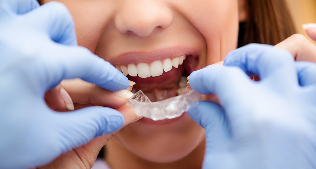 Invisalign: niềng răng không mắc cài hoặc niềng răng khay trong suốt