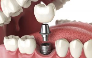 Cấy ghép Implant: Giải pháp tối ưu cho người bị mất răng lâu năm