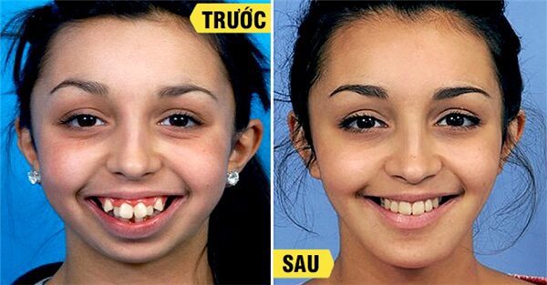 "Độ tuổi vàng” để niềng răng từ 7 đến 10 tuổi