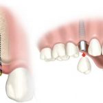 kỹ thuật trồng răng Implant được coi là giải pháp giúp khôi phục lại răng đã mất một cách toàn diện