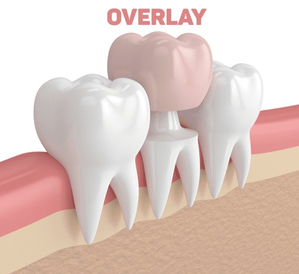 Phục hình răng Overlay