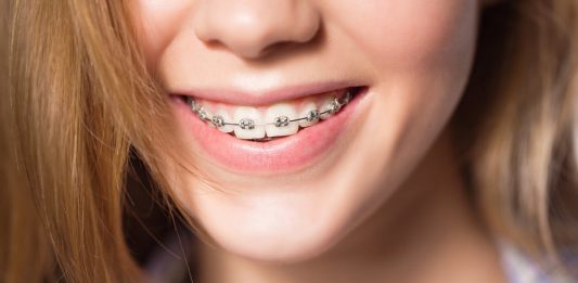 Ưu - nhược điểm của các loại mắc cài trong niềng răng