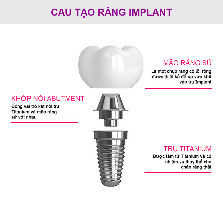 Trồng răng Implant là cả một quá trình đầu tư về thời gian và chi phí