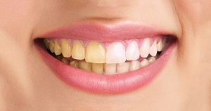Có nên lấy cao răng thường xuyên không?
