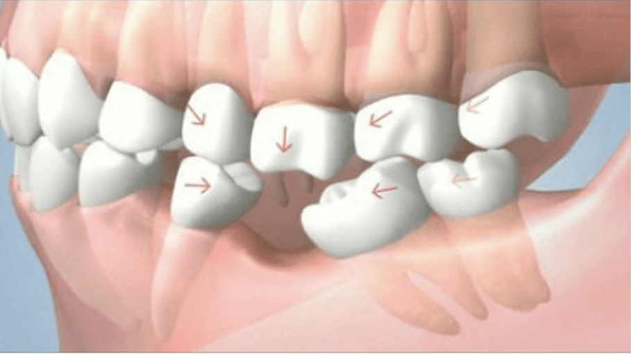 Tác hại của mất răng