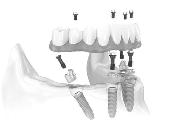 Trồng răng cấy ghép implant