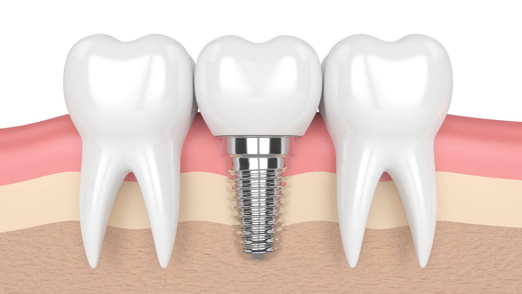 rong đó, trồng răng implant là phương pháp tiên tiến, chất lượng nhất