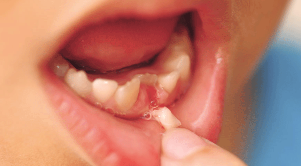 Hậu quả của mất răng sữa sớm