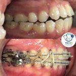 Khớp cắn hở được xử lý bằng niềng răng công nghệ geaw