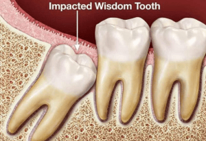 Răng khôn là gì? Mỗi người có mấy răng khôn