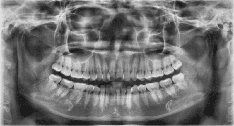 Ảnh chụp X-quang cho phép quan sát cấu trúc toàn bộ hàm răng
