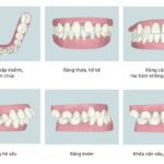 Các khuyến điểm của răng có thể được xử lý bởi phương pháp niềng răng