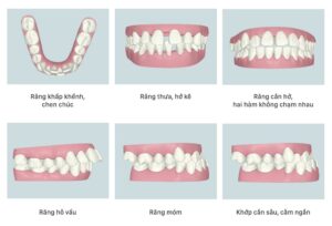 Các khuyến điểm của răng có thể được xử lý bởi phương pháp niềng răng